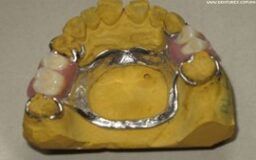 129 Partial Denture 3