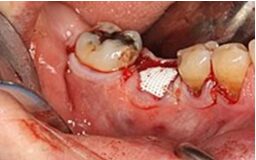 143 Bone Regeneration