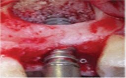 147 Sinus Bone Graft