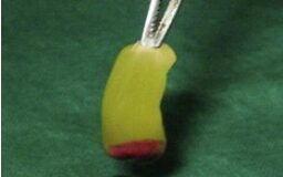 148 Platelet Rich Fibrin
