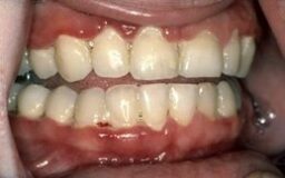 152 Necrotizing Ulcerated Gingivitis