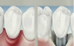 153 Periodontitis - Perioimplantitis