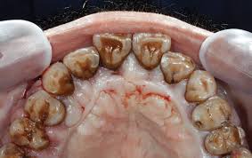 162 periodontitis